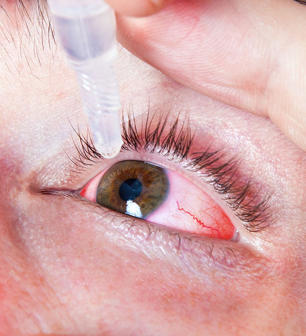  Occhi rossi e lenti a contatto: cause e rimedi