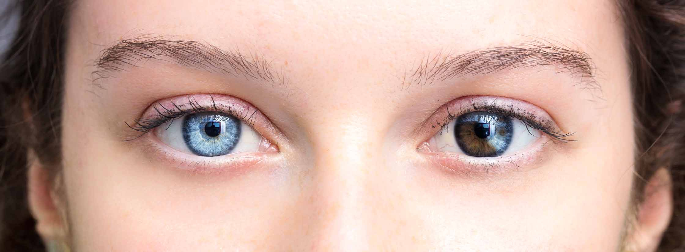 Gros plan des yeux d’une femme atteinte d’hétérochromie