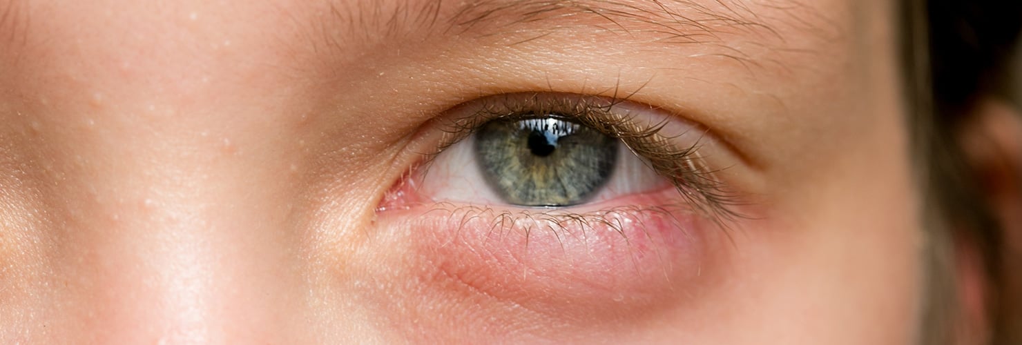 Ojos y párpados hinchados: ¿Qué lo causa y cómo se trata?