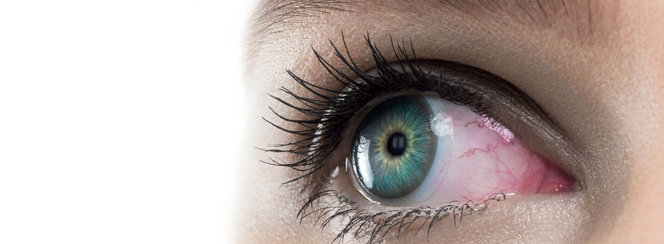 Een close-up van een rood oog met een contactlens in
