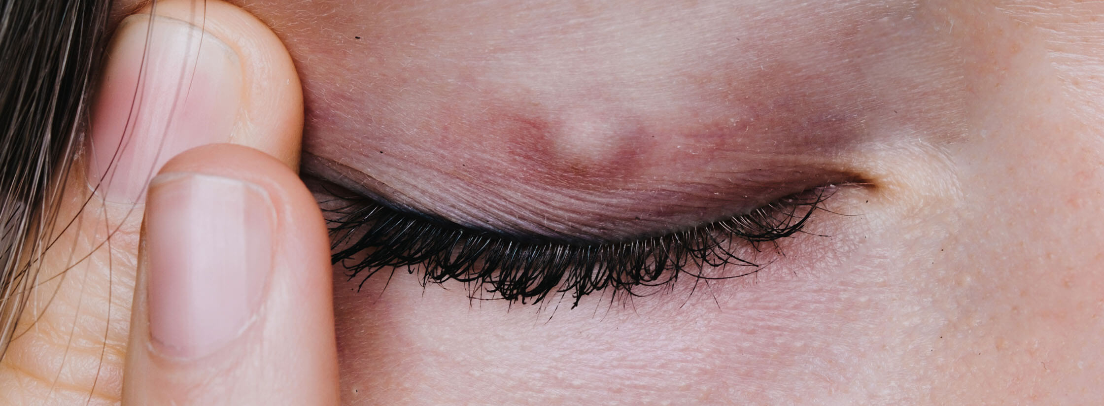 Een close up van een ooglid met een chalazion