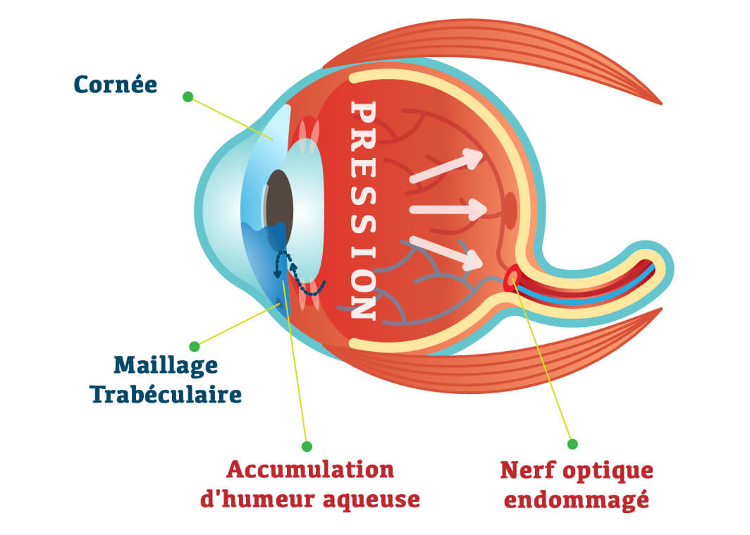 Glaucome schéma oculaire