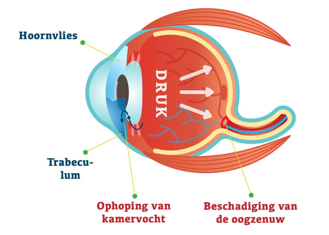 Een tekening van een oog met glaucoom